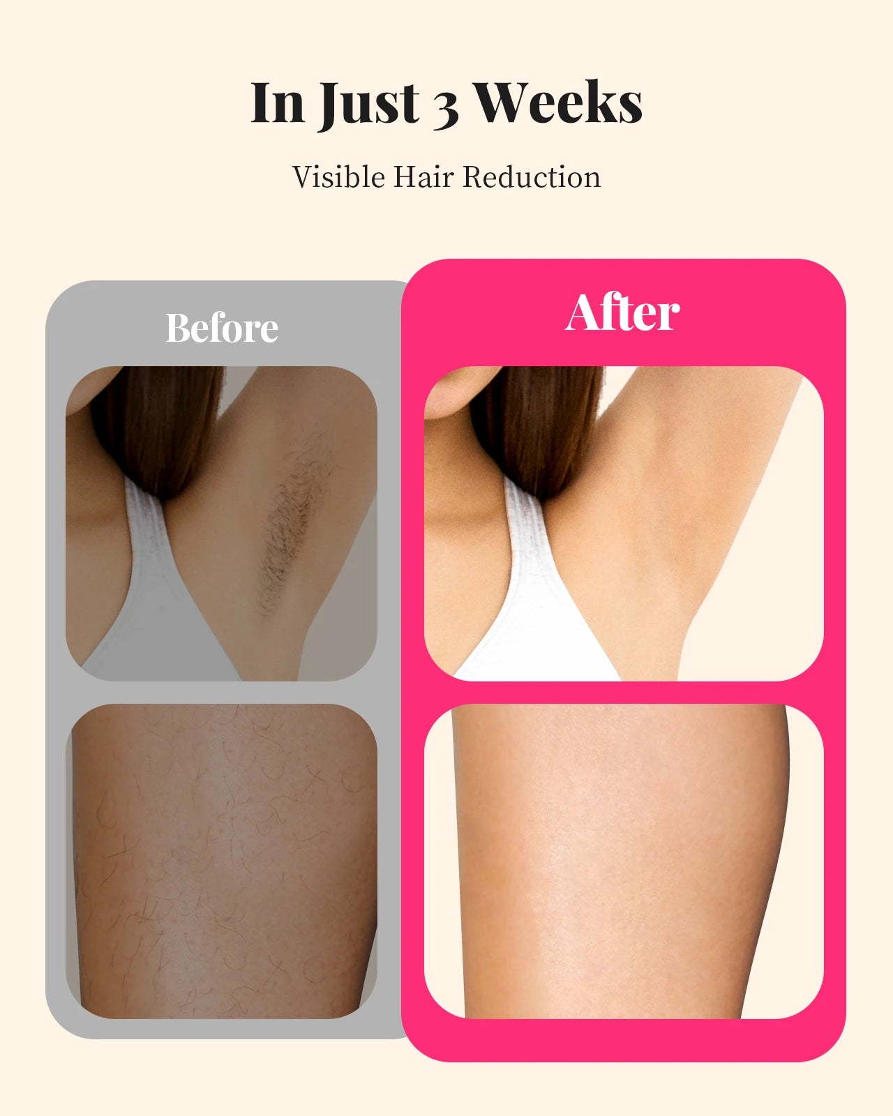BeautyByOla – 990000 Flashes IPL Laser Hair Removal, Painless Permanent Hair Removal for Women & Men, Body, Bikini & Face