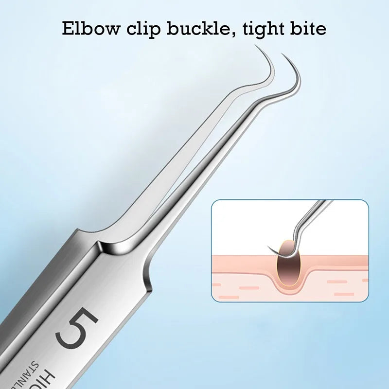 German No.5 Blackhead Remover Tweezers Ultra-Fine Acne Tool – BeautyByOla