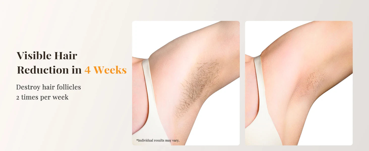 BeautyByOla – IPL Hair Removal Device, Unlimited Flash Ice-Cooling Laser, Painless Full Body Treatment for Women & Men