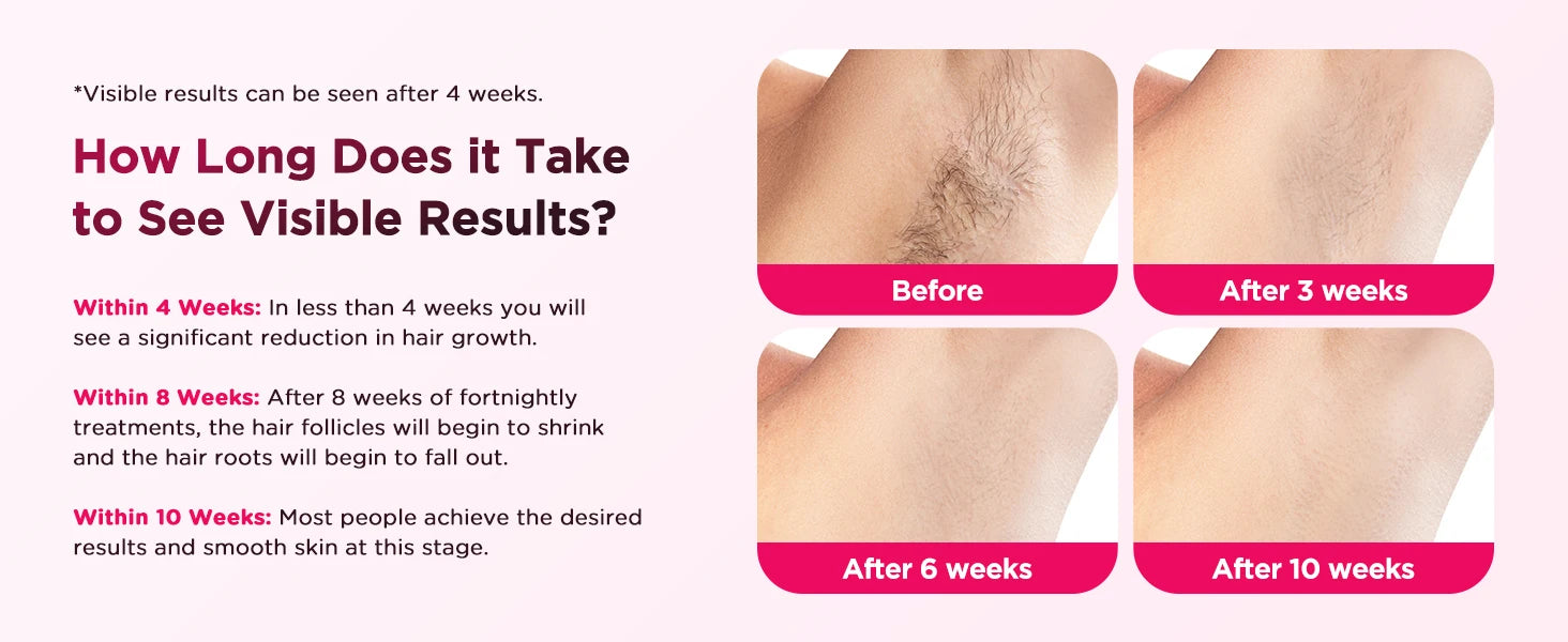 BeautyByOla – 990000 Flash IPL Laser Hair Removal, Painless Epilator for Men & Women, Body, Bikini & Facial
